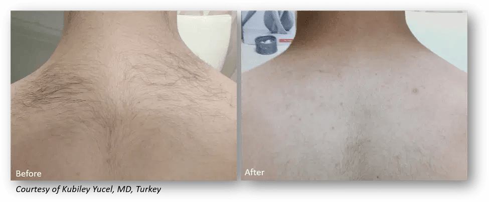  laser hair removal treatment Seattle and Kirkland